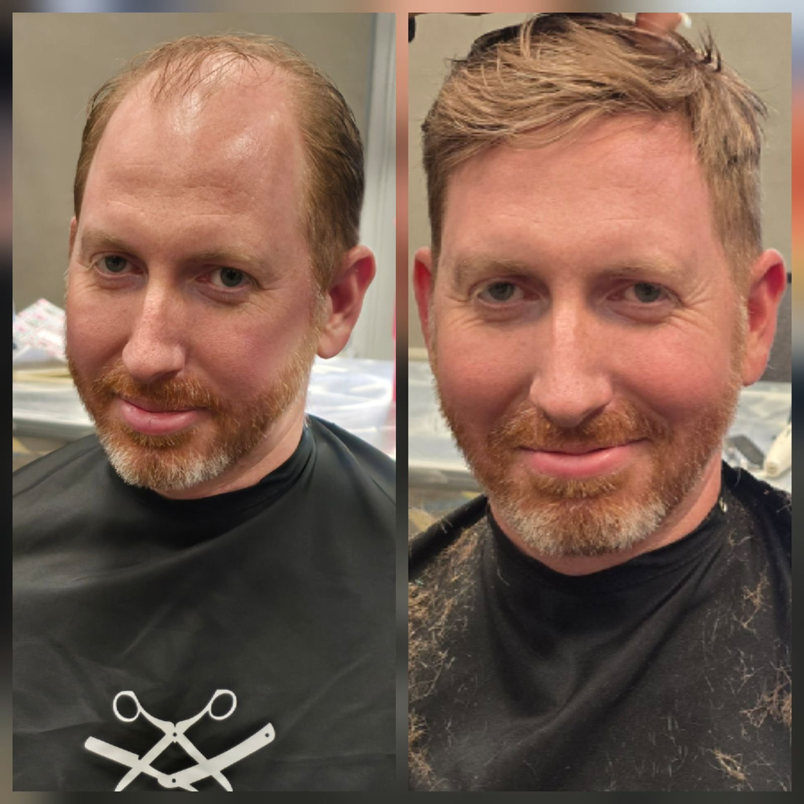 Hair replacement result