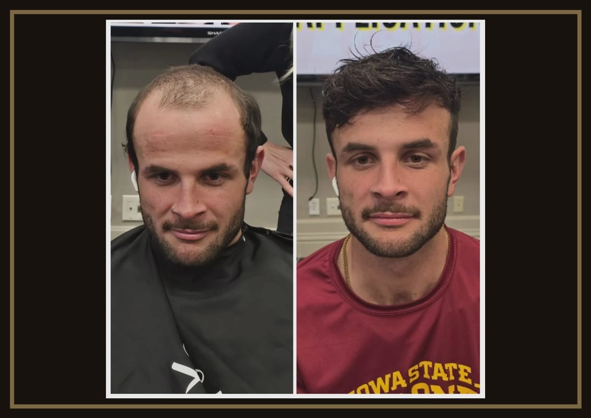 Non-Surgical Hair Replacement